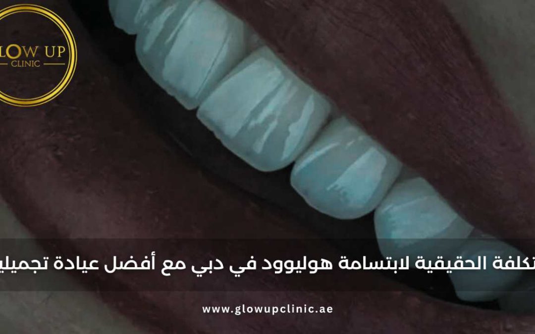 التكلفة الحقيقية لابتسامة هوليوود في دبي مع أفضل عيادة تجميلية
