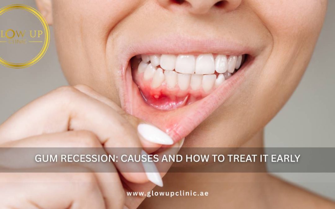 Gum Recession: Causes and How to Treat It Early