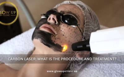 Carbon Laser: What Is the Procedure and Treatment?