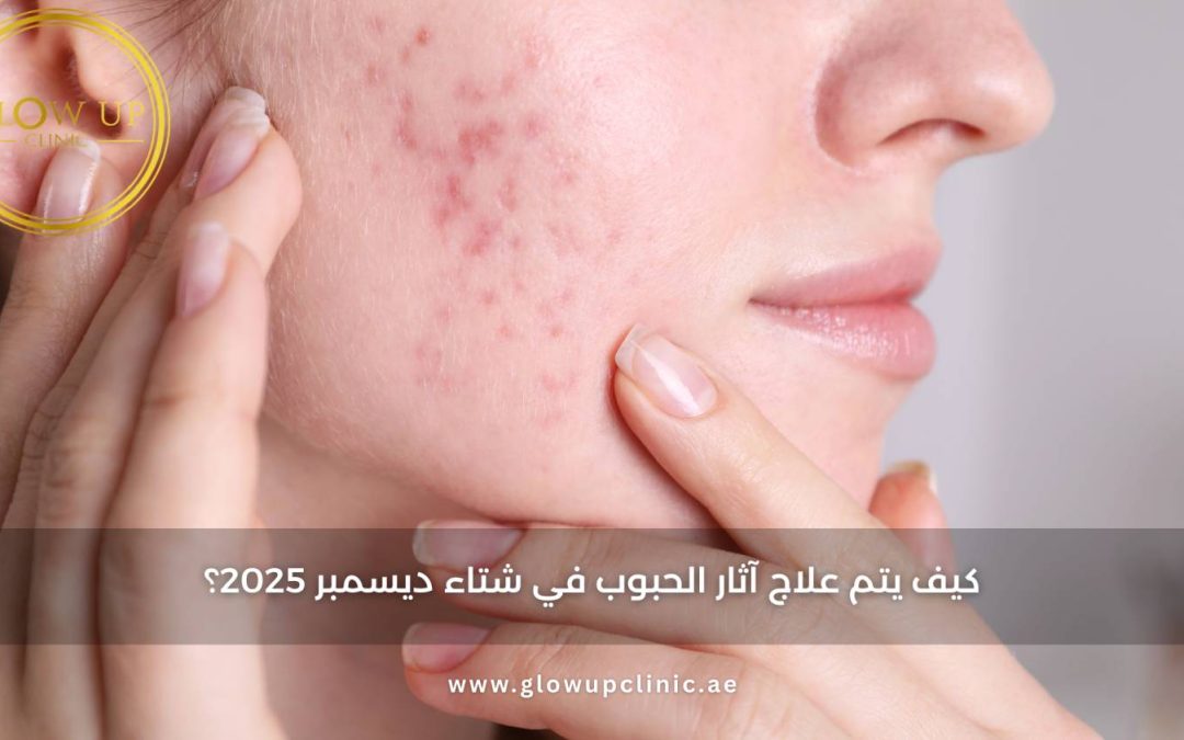 كيف يتم علاج آثار الحبوب في شتاء ديسمبر 2025؟