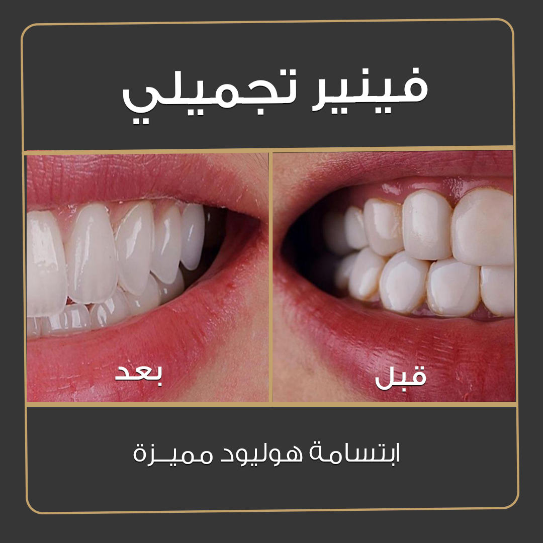 dental veneers